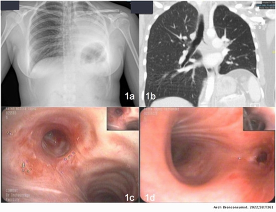 Endobronchial Tuberculosis {faces}